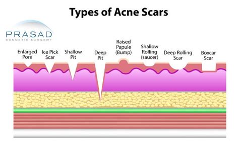 Acne Scars Treatment | NYC and Long Island | Prasad Cosmetic Surgery