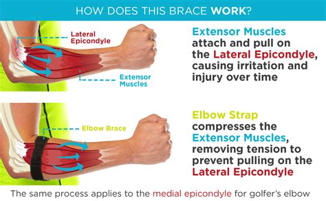 Medial Epicondylitis Test