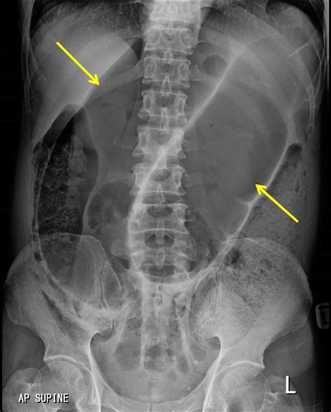 Sigmoid volvulus – Radiology Cases