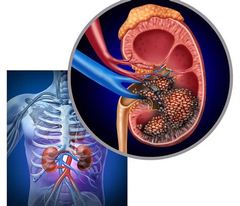 An Overview of Kidney Cancer - symptoms, causes and treatment ...