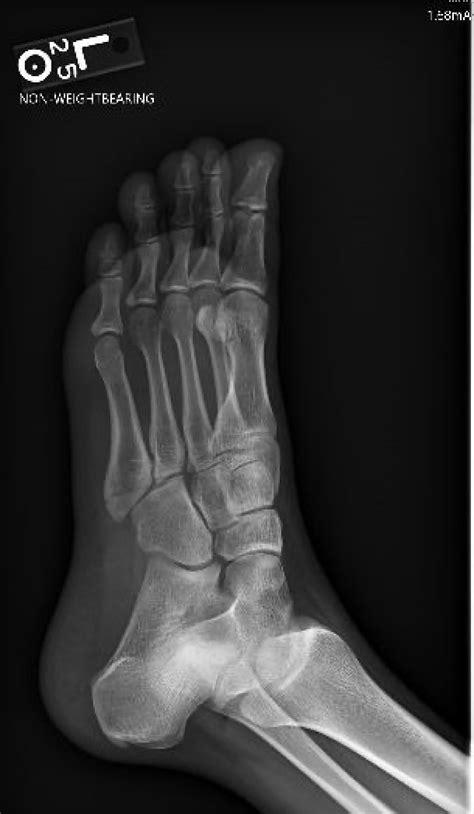 Case Report: Fifth Metatarsal Fracture - Sports Medicine Review