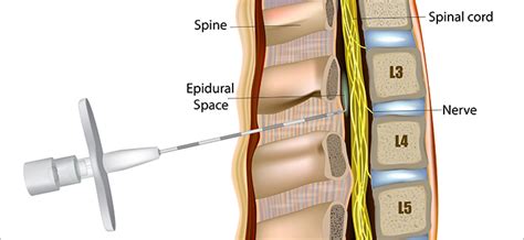 Epidural Steroid Injections - Texas Back Institute