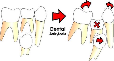 What are Ankylosed Teeth? | Ask an Orthodontist.com