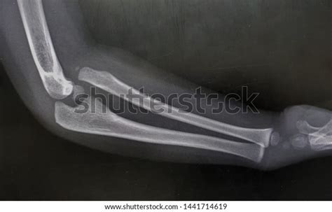 Xray Show Congenital Radial Head Dislocation Stock Photo 1441714619 ...