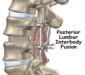 Spinal Fusion Surgery (PLIF/TLIF) - Procedure & Treatment in India ...