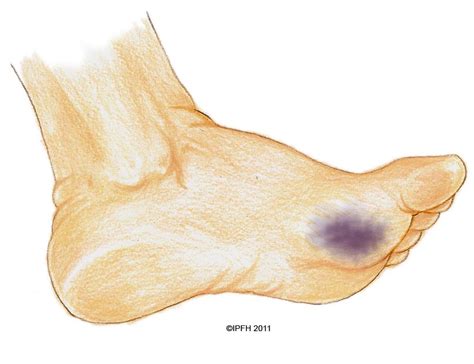 Bruise | Institute for Preventive Foothealth (IPFH)