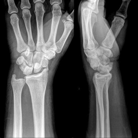 Scaphoid Dislocation