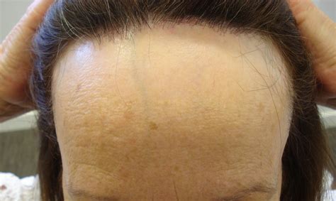 Frontal Fibrosing Alopecia and Sunscreens - Dr Paul Farrant