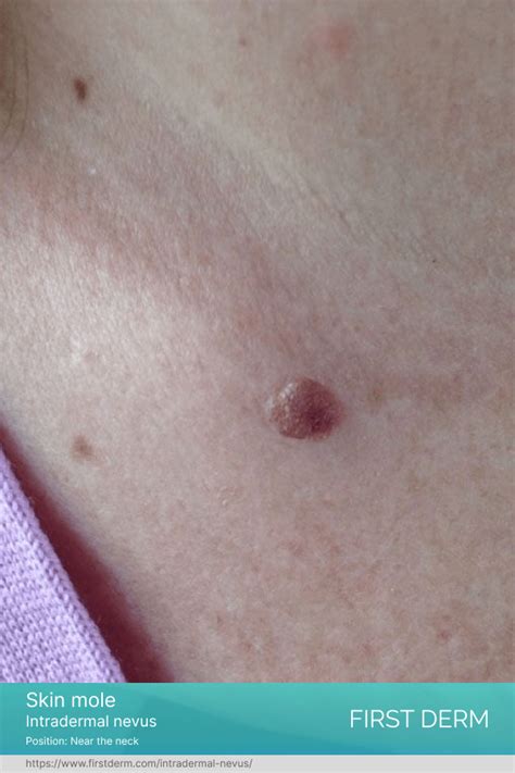 Intradermal nevus | First Derm