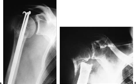 Complications of Proximal Humeral Fractures | Musculoskeletal Key