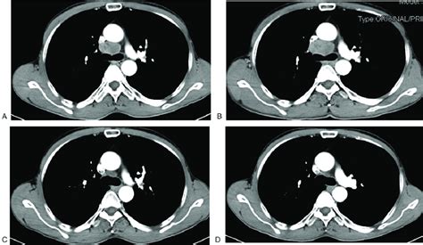 A, The mediastinal lymph node metastasis before Brivanib alaninate ...