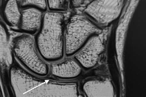 Scapholunate Ligament Anatomy