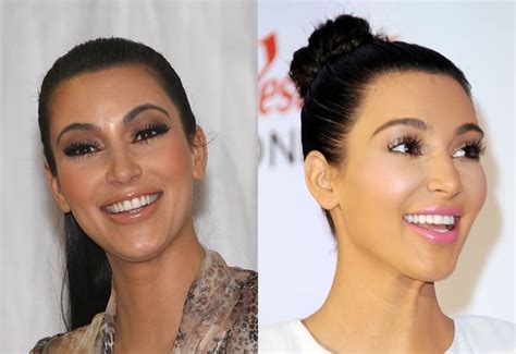 Kim Kardashian Porcelain Veneers Before And After Pictures