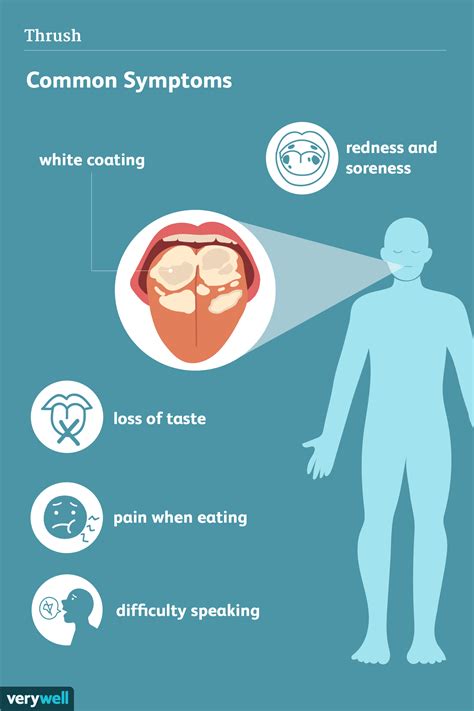 Oral Thrush Symptoms In Adults Outlet | mca-tv.org