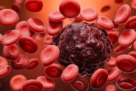 BLOOD CANCER - Causes, Symptoms & Treatment | CBCC India