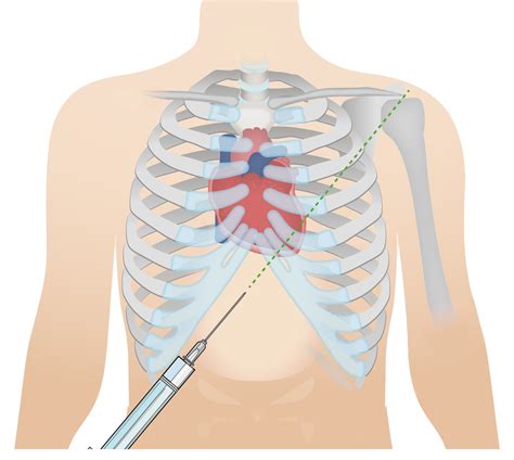 Ecg Pericardial Effusion | Sexiz Pix