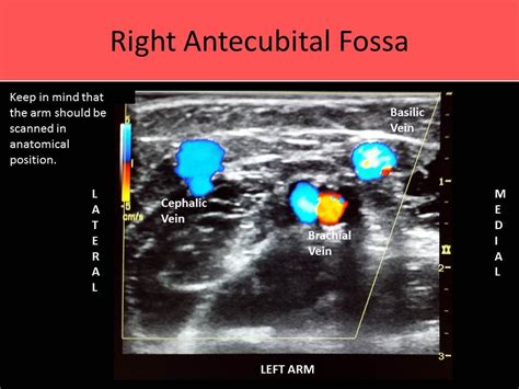 Upper Extremity Arterial Anatomy Ultrasound