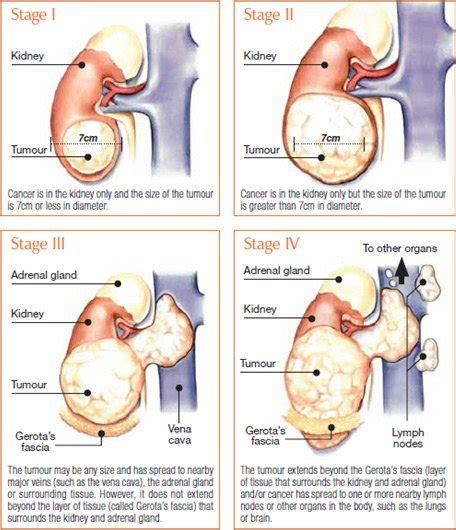 OHC Kidney Cancer Stage 1, 2, 3, 4 - OHC - Oncology Hematology Care