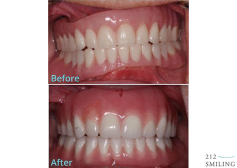 Dentures Female Before and After - 212 Smiling