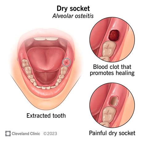 Dry Socket: What It Is, Symptoms & Treatment