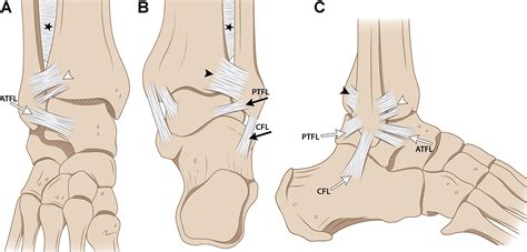 Medial Ankle Ligaments Mri