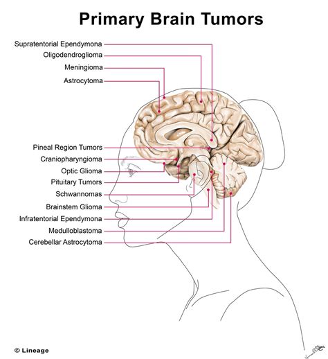 Brain Tumor Size Chart: A Visual Reference of Charts | Chart Master