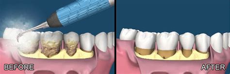 Flap Surgery – Altamash Dental Clinic