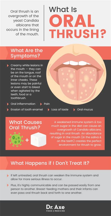 Thrush Causes And Symptoms In Babies