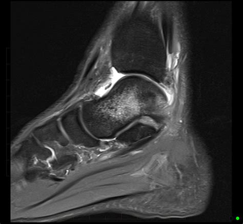 mri-ankle-anterior-talofibular-ligament-rupture-2 - MRI at Melbourne ...