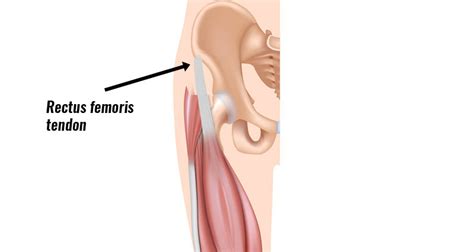 Rectus femoris tendinopathy - Sportsinjuryclinic.net