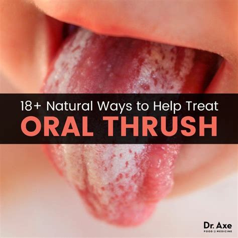 Oral Thrush In Pregnancy Cks