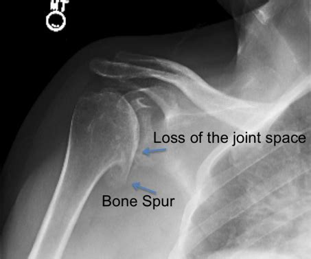 Shoulder Arthritis | UW Orthopaedics and Sports Medicine, Seattle