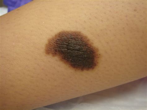 CONGENITAL MELANOCYTIC NEVUS – Dermatology Conditions and Treatments