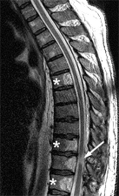 Vertebral Hemangioma | Radsource