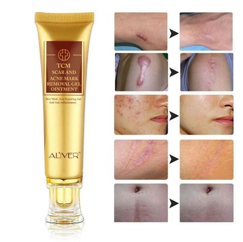 Aliver Scar Removal Cream and Acne Treatment Cream - Effectively Remove ...