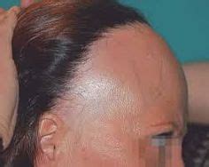 DIAGNOSIS AND TREATMENT OF FRONTAL FIBROSING ALOPECIA Frontal fibrosing ...