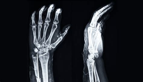 Wrist X-Ray: Anatomy, Procedure & What to Expect