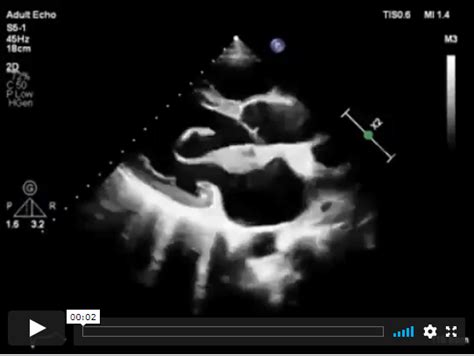 Myxomatous Mitral Valve