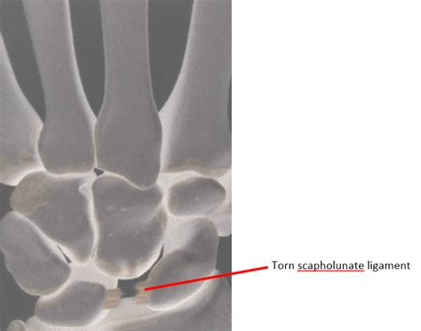 Radial-Sided Wrist Pain: The Scapholunate Ligament Injury - Mount ...