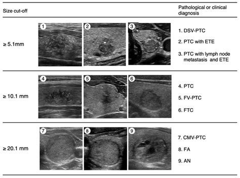 Thyroid Ultrasound Cancer