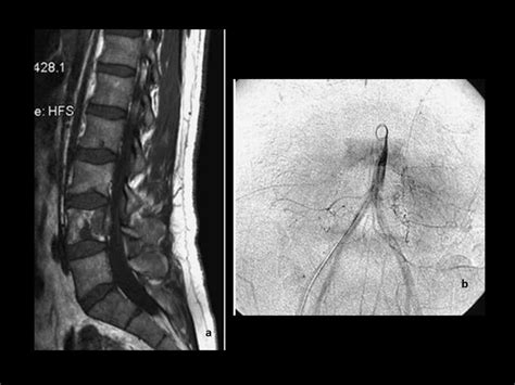 a. Sagittal MR imaging of the lumbar spine of a patient with hemangioma ...