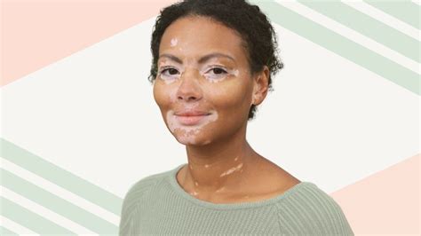 Vitiligo New Treatment 2024 - Linda Paulita