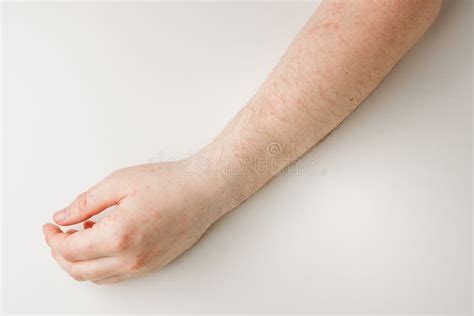 Male Hand on White Table with Red Spots on Skin. Allergic Reaction ...