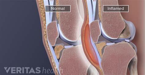 Knee (Prepatellar) Bursitis