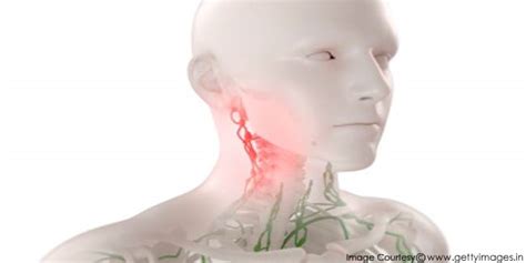 Early Stage Cancer Lymph Nodes In Neck Symptoms Lymphedema Causes 27950 ...