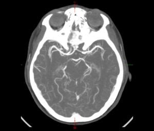 CT Brain Angiogram | Precise Radiology