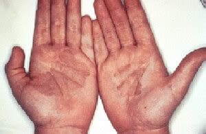 Hand Fungus – Symptoms, Causes, Pictures and Treatment : Health Blog