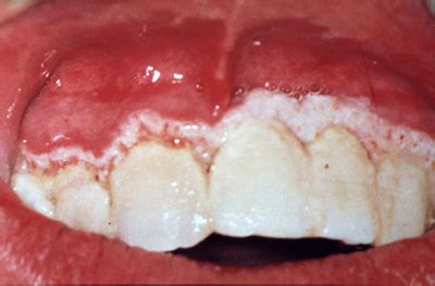 Necrotizing Ulcerative Gingivitis Before And After