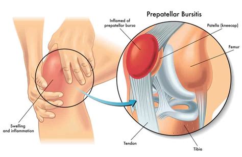 Prepatellar Bursitis | Orthopaedic Knee Injury Specialist