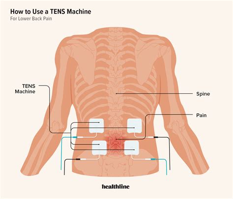 TENS Unit for Lower Back Pain: Placement and Instructions | Ten unit ...